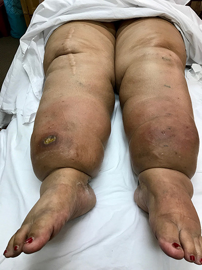image of patient suffering edema in legs