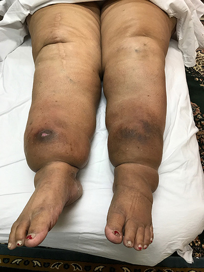image of patient suffering edema in legs