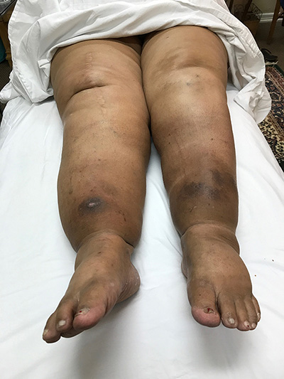 image of patient suffering edema in legs - using edemawear